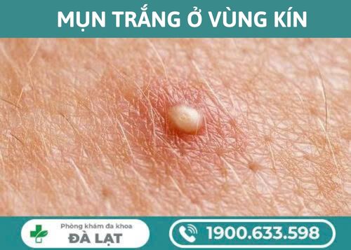 Hình ảnh minh họa